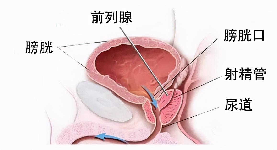 前列腺炎治療周期詳解，前列腺炎治療周期全面解析