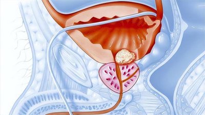 前列腺炎的治療費用分析，前列腺炎治療費用詳解