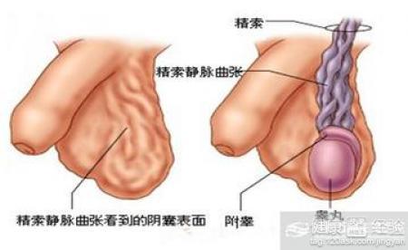 精索靜脈曲張可以自愈嗎？解析與探討，精索靜脈曲張能否自愈？解析與探討