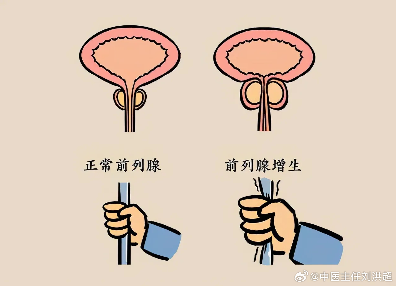 前列腺結(jié)石與性功能障礙，是否存在關(guān)聯(lián)？，前列腺結(jié)石與性功能障礙的關(guān)聯(lián)探討，是否存在潛在聯(lián)系？