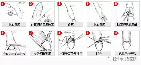 關(guān)于做包皮手術(shù)是否疼痛，一種全面的解讀與應(yīng)對(duì)建議，包皮手術(shù)疼痛解讀及應(yīng)對(duì)建議，全面解析與指導(dǎo)